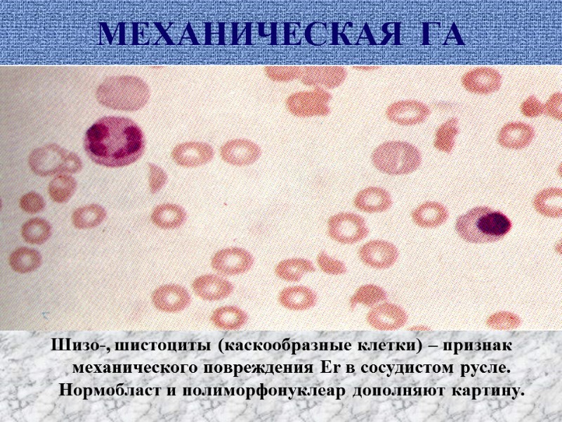 МЕХАНИЧЕСКАЯ  ГА Шизо-, шистоциты (каскообразные клетки) – признак механического повреждения Er в сосудистом